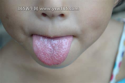 舌头根部有小疙瘩图片,可能由三种原因引起的