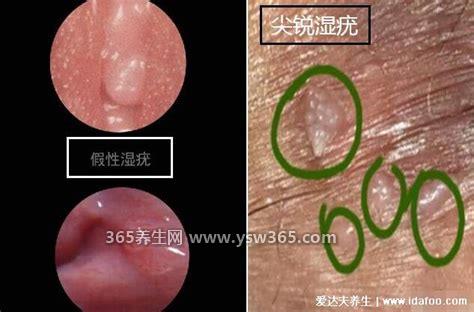 女性假疣和真疣的区别图片,假疣表面是光滑的/会摸到很多小颗粒