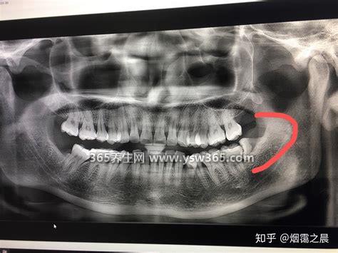 拔智齿一般费用多少钱一颗,拔一颗智齿要2-3千元
