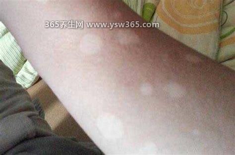 轻度白癞风图片,身上有白斑时可能就是白癜风了