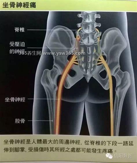 坐骨神经痛的疼点图,如果发现不明原因的疼痛要及时就医