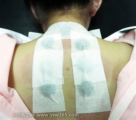 三伏贴价格多少钱,收费标准不一样/有的医院一个穴位收费30元