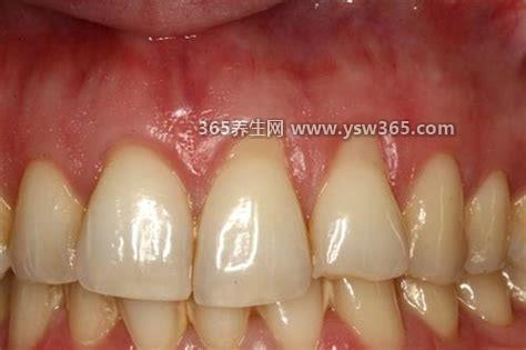 牙龈萎缩怎么办教你一招自愈,用无菌棉签蘸3%双氧水擦拭
