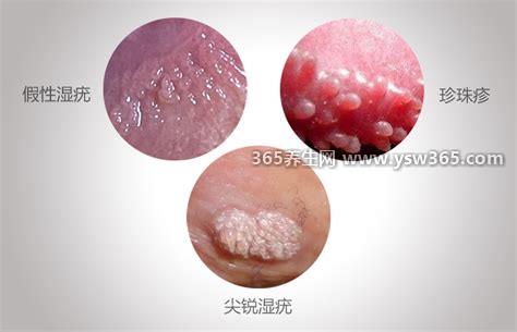 假疣和真疣的区别图,珍珠丘疹性疣是假性疣/尖锐湿疣是真性疣
