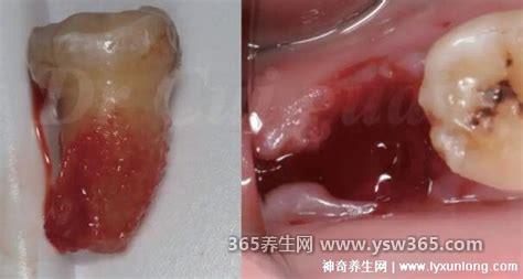 拔牙后七天窟窿恢复图真实,基本一个月就会完全恢复了