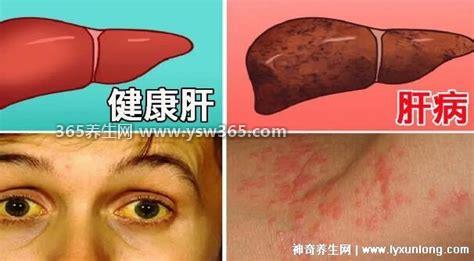 三个症状说明有肝癌了,右腹腔上部有疼痛就需要注意了