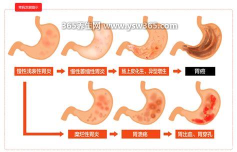 胃病最严重的三个征兆,疼痛频繁/持续时间长小心是胃病