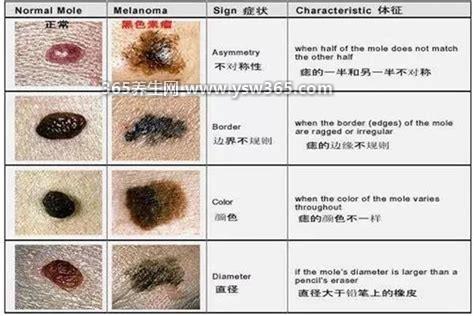 先天性巨痣图片癌变几率大吗,癌变概率在0.9-2.8%之间