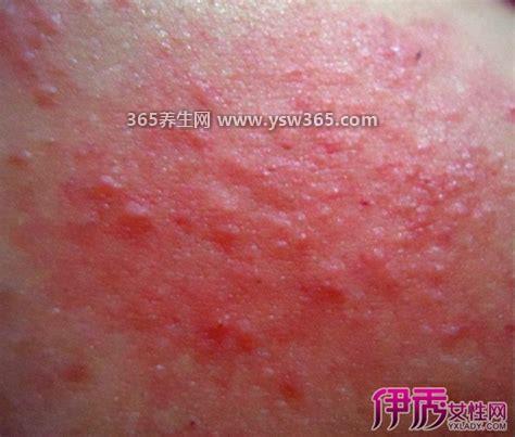 血毒血热引起皮肤病图片,要注意饮食清淡多喝水