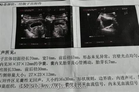 生男生女其实看孕囊很准,准确率高达80%