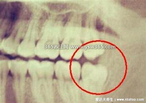 埋伏牙一定要拔吗有什么危害,建议拔/时间长了牙齿会很疼