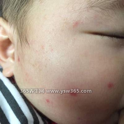 白血病初期针孔小红点图片不痒不疼,一般是出血引起的