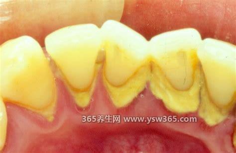 牙结石图片及症状是什么样,呈棕色或黑色/与口腔卫生不良有关