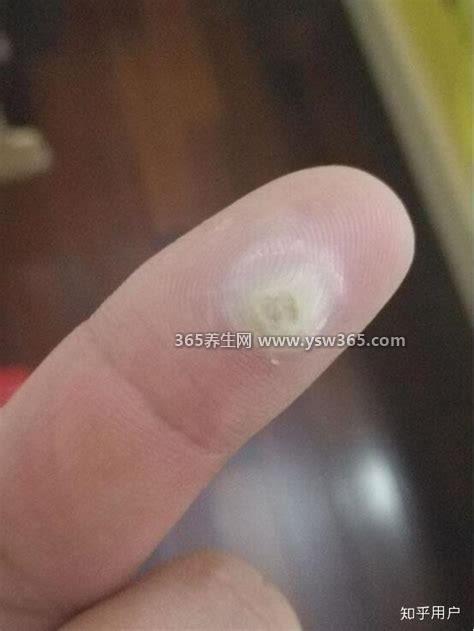 鸡眼怎么去除最好方法,涂抹芦荟每天涂一次用医用纱布固定