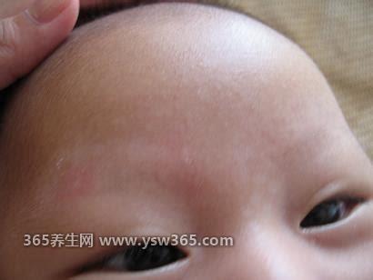 如何判断白斑是不是白风图片,白癜风可发生在身体的任何部位