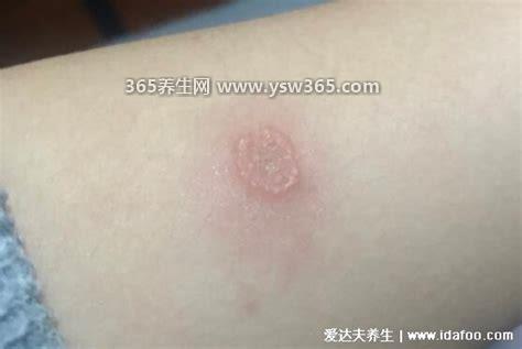 100种癣对照图及名称,包括足癣/头癣/手癣/面癣/股癣和体癣