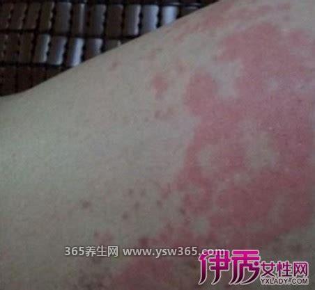 出血热皮肤病图片及症状,患者全身出现红色皮疹还有高烧