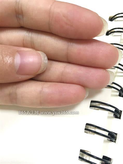 手指甲分层是怎么回事是缺什么,大多是蛋白质和维生素的缺乏