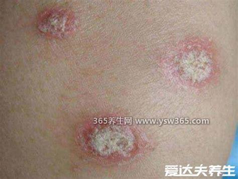 不同类型的银屑病图片,有三个征象鳞屑(皮屑)/膜和出血点
