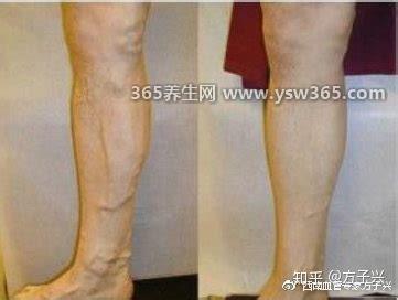 早期小腿静脉曲张图片症状,皮肤表面突起的血管像蚯蚓一样