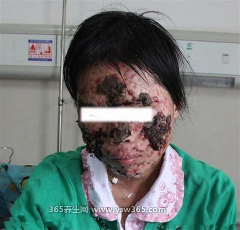 女人艾滋病的三大症状图片,如:皮肤上长很多小红点(各个部位)