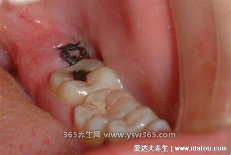拔智齿后那个洞臭到恶心,这种情况很可能是牙神经坏死