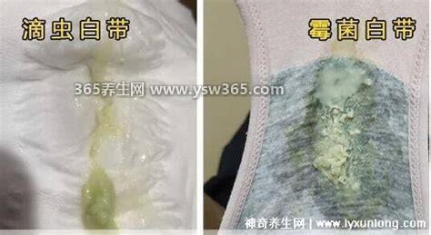 怎么判断霉菌还是滴虫,白带异常增多看起来像豆腐渣(霉菌性)