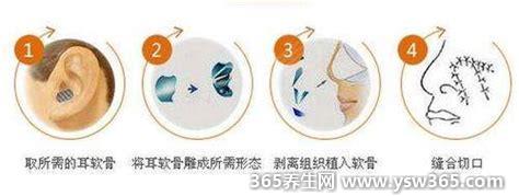 耳软骨鼻多少钱和肋软骨鼻哪个好,价格在8000-25000元左右