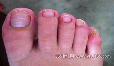感染甲流的前兆是什么感觉,发病很急突然出现39度的高烧