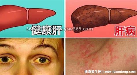 三个症状说明有肝癌了,肝区异常疼痛/发烧消化不良要警惕