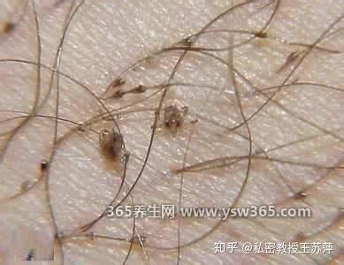 阴虱是什么原因得的,主要是被X生活感染的