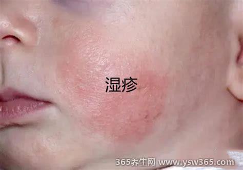 一张图教你区别湿疹和痱子-症状不一样/长的地方不同