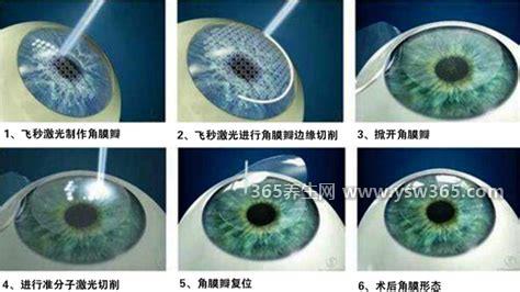 激光治近视大概多少钱,准分子激光4000-6000元不等