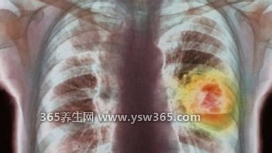 肺癌晚期患者临终前15个症状,消瘦/嗜睡/不能进食/声音嘶哑等