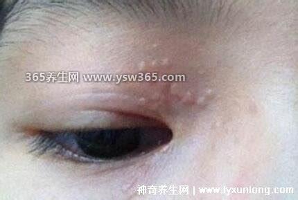1个疣体激光一次多少钱,如果面积比较小价格在200元左右