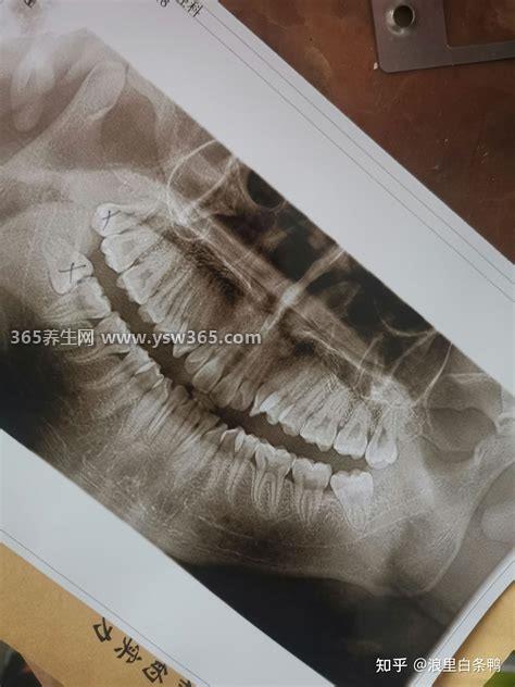 拔了智齿后悔终身,智齿不痛不痒咬合力正常是不需要拔牙的
