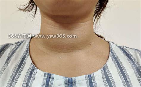 女性大脖子病图片,最显著的特点就是脖子变粗