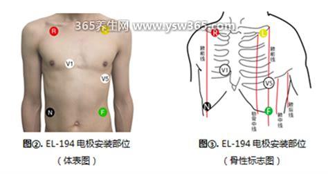 心电监护5个电极位置图及对应颜色,右上导联为白色/左上引线为黑色
