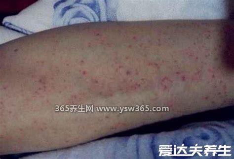 白血病初期小血点图片及症状,有贫血/出血/发热等症状