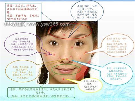 脸部对应的五脏六腑图起痘,脸颊上的粉刺对应左肝和右肺