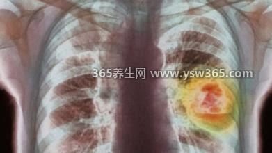 肺癌晚期临终前三天8大症状,吃不下/嗜睡/呼吸困难等症状