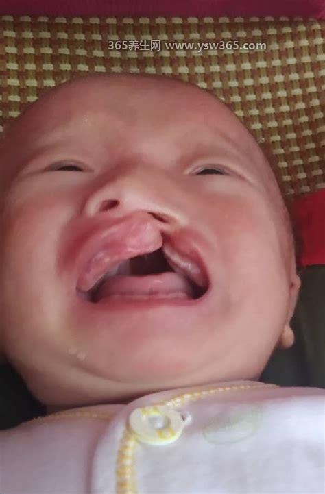宝宝唇腭裂图片大全,是一种常见的先天性畸形(遗传因素)