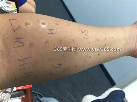 医生为什么不建议查过敏源,原因有三(过敏时间短没必要查)