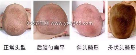 佝偻病方颅图片和正常对比图片,可以看孩子的头型