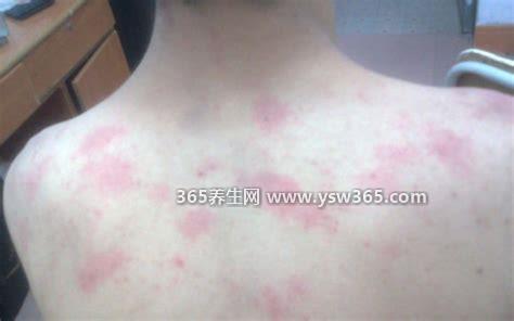 荨麻疹最怕三个土方法,向白酒中加入醋几分钟就有效果