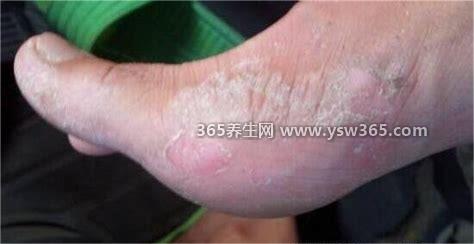 100种癣的种类与辨别图片,体癣/手癣/面癣/灰指甲/足癣等