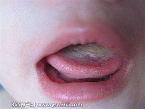 初早期婴儿鹅口疮图片及症状图,发现宝宝嘴里有白色的东西要注意了