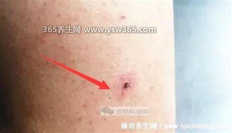 蜱虫最怕这3种东西,.害怕火/酒精和它的天敌