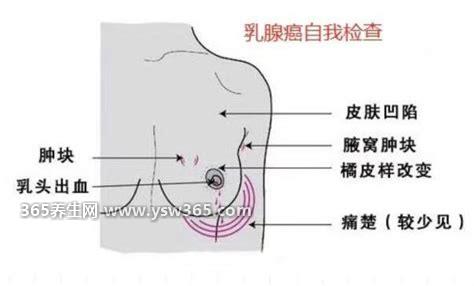 乳腺癌的15个征兆图片,乳房肿块/乳房凹陷/乳头溢液等等