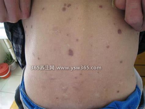 男性下面感染早期症状图片,梅毒/尖锐湿疣/带状疱疹都是常见X疾病